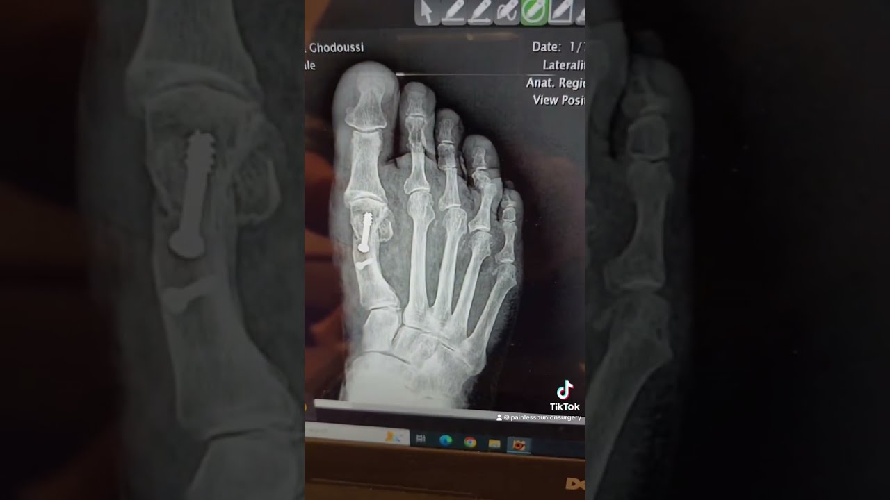THE IMPOSSIBLE IS POSSIBLE Shorts Viralshorts Bunions Painlesssurgery Recovery Transformation