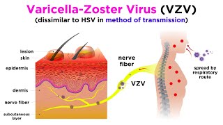 Chickenpox and Shingles (Varicella-Zoster Virus)
