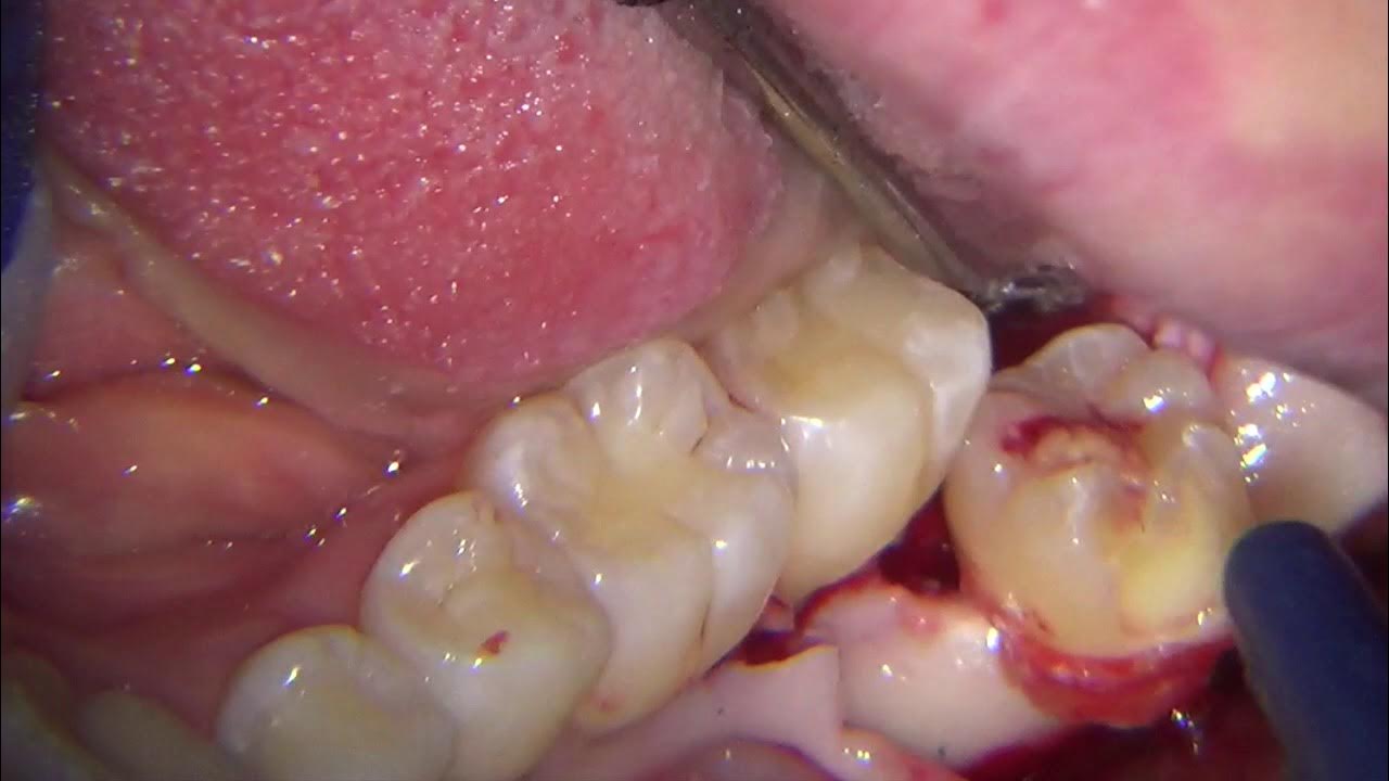 Lower third molar extraction with microscope YouTube