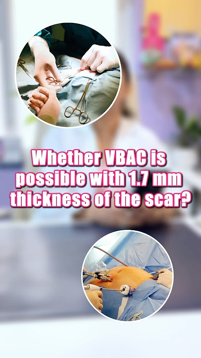 Is Vbac possible with a 1.7mm scar thickness? #drkshilpireddy #vbacsuccess #vbac #vbacdelivery
