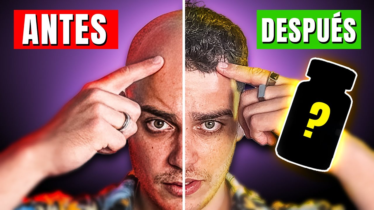 Así vencí la calvicie