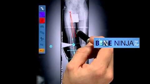 Demo of the Bone Ninja App