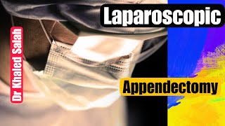Difficult Laparoscopic appendectomy | Khaled Salah