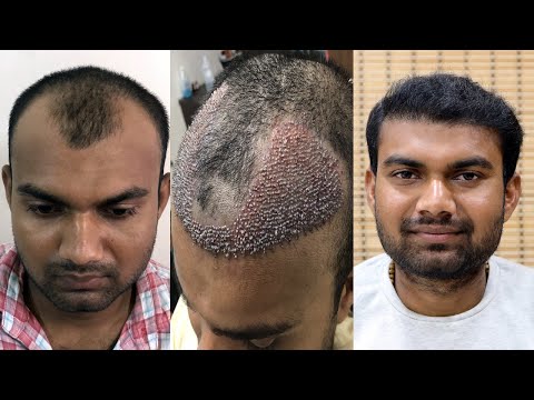 safe-hair-transplant-|-best-fue-hair-transplant-result-2019-|-new-roots-hair-clinic