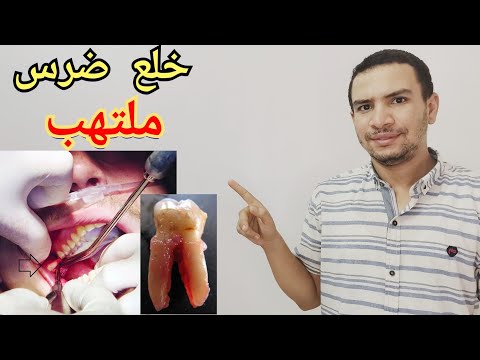 فيديو: هل قلع الأسنان آمن؟