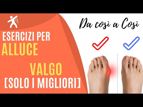 Video: Alluce Valgo Delle Articolazioni Del Ginocchio