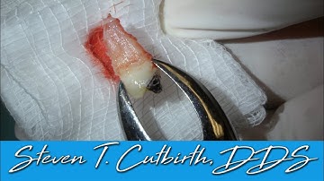Extracting Tooth for Orthodontics - Dental Minute with Steven T. Cutbirth, DDS