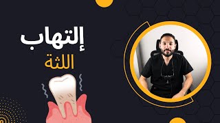 إلتهاب اللثة: أسبابه وطرق علاجه