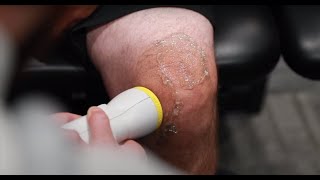 Knee Replacement Avoided Using Softwave Therapy