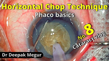 Cataract vlog no,08 - Horizontal chop technique , Phaco basics - Dr Deepak Megu