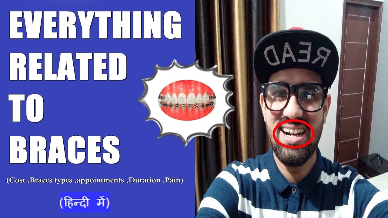 Everything Related To Braces in Hindi जानिये ब्रेसेज के बारे मे सारी
