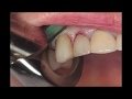 Atraumatic extraction using physics forceps fractured endo treated cuspid tooth  goldendent