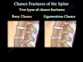 Chance Fractures of the Spine - Everything You Need To Know - Dr. Nabil Ebraheim