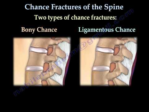 Chance Fractures of the Spine - Everything You Need To Know - Dr. Nabil Ebraheim