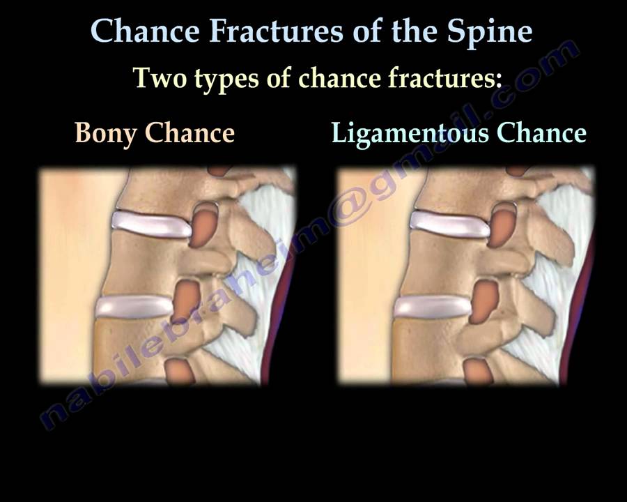 Chance Fractures of the Spine - Everything You Need To Know - Dr. Nabil  Ebraheim 