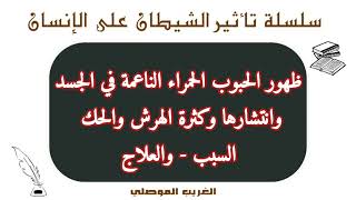 انتشار الحبوب الحمراء الناعمة في الجسد وكثرة الهرش والحك - سلسلة تاثير الشيطان على الإنسان