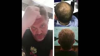 Nacho Vidal Y Su Injerto De Cabello Con Dhi