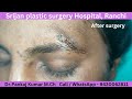 Scar revision surgery| Micro scar revision surgery for tiny scar| Best scar revision surgery 