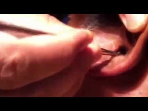 فيديو: صرصور يخترق أذن الرجل الأسترالي