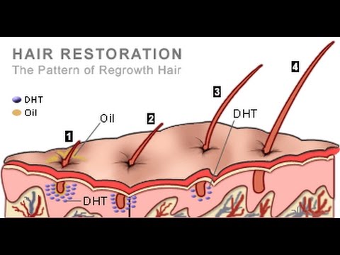 The Best Dht Blocker Food I Have Personally Use It Hair Regrowth