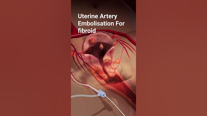 uterine artery embolisation for fibroid # fibroid #health