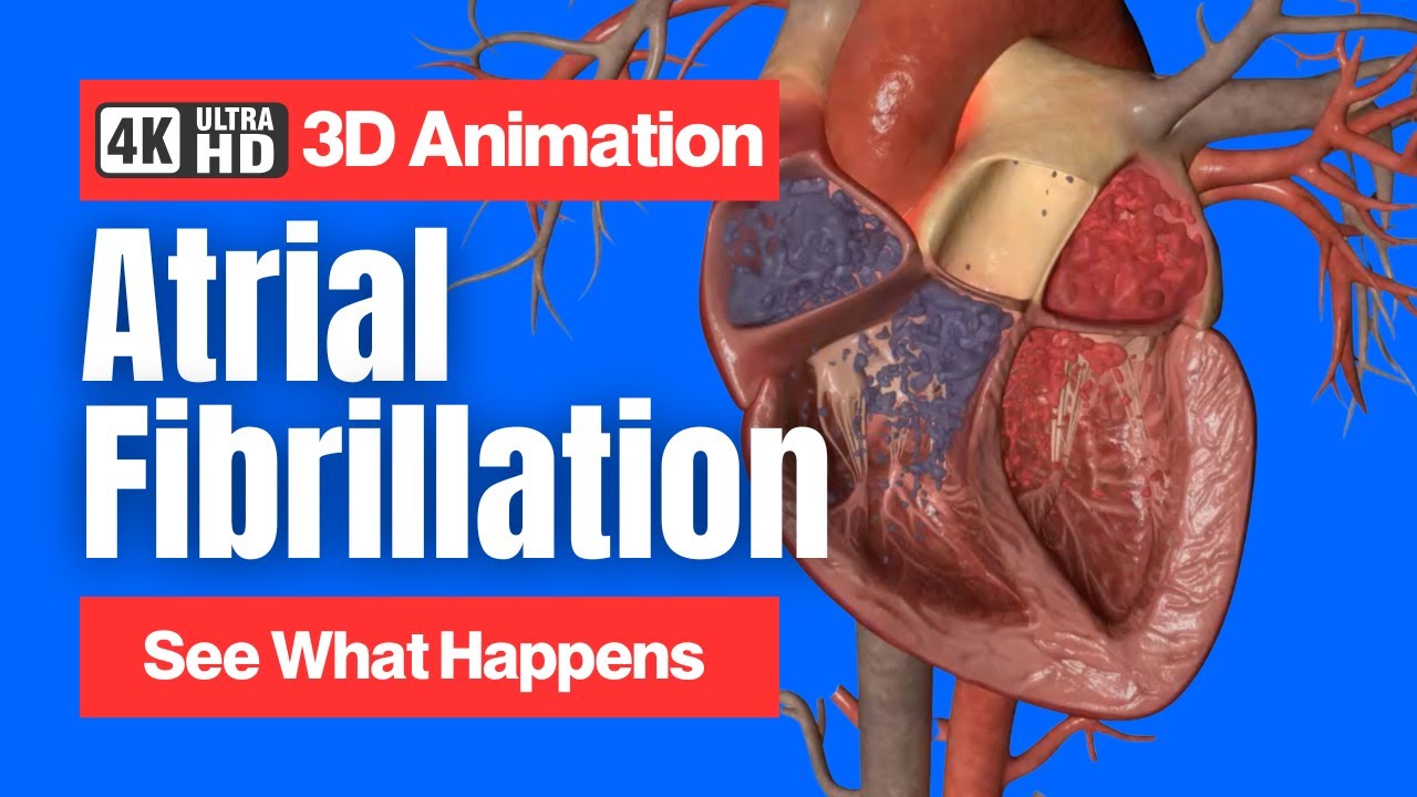 Atrial Fibrillation (AFib) - 3D Animation - YouTube