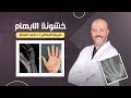 خشونة مفصل الابهام طريقة التفكير للدكتور احمد العطار