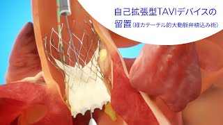 自己拡張型TAVIデバイスによるTAVI（経カテーテル的大動脈弁植込み術）