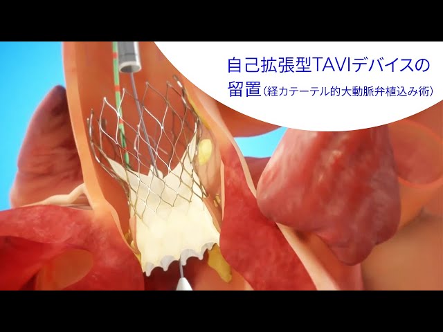 TAVI 実践マニュアル Amazon.co.jp: TAVI実践マニュアル : 林田 健太郎, OCEAN-SHD