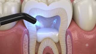 Sandwich technique in dentistry