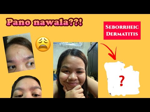 Video: Paano Magagamot ang Seborrheic Dermatitis sa Iyong Mukha (na may Mga Larawan)