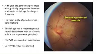 Tough PVD induction in rhegmatogenous retinal detachment