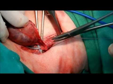Vídeo: Adenoma De Tiroides: Cirugía