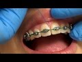 Flossing Braces With a Threader
