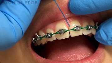 Flossing Braces With a Threader