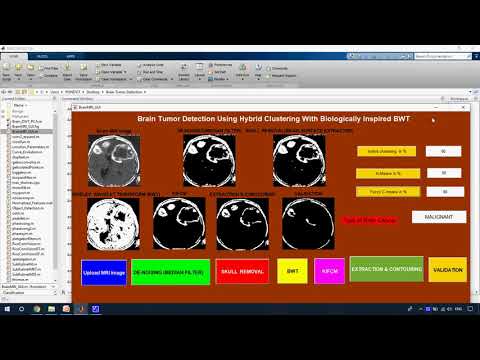 Brain tumor segmentation based on a hybrid clustering techniques