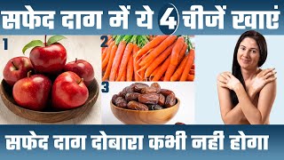 ये 4 चीज़ें खाओ - सफ़ेद दाग भगाओ | Vitiligo Control Tips | Vitiligo Diet Plan