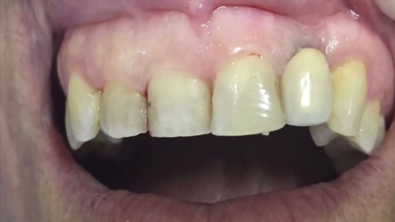 Como fazer guia de cirurgia periodontal no meshmixer