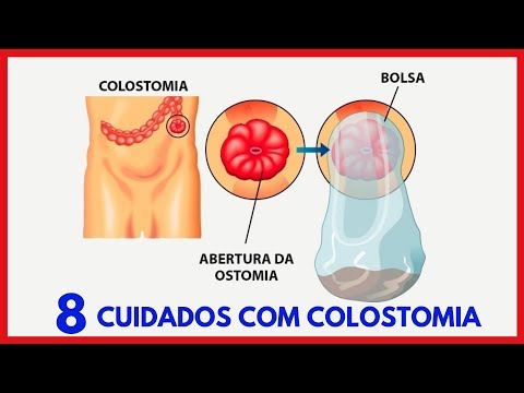 Cuidados de enfermagem com colostomia