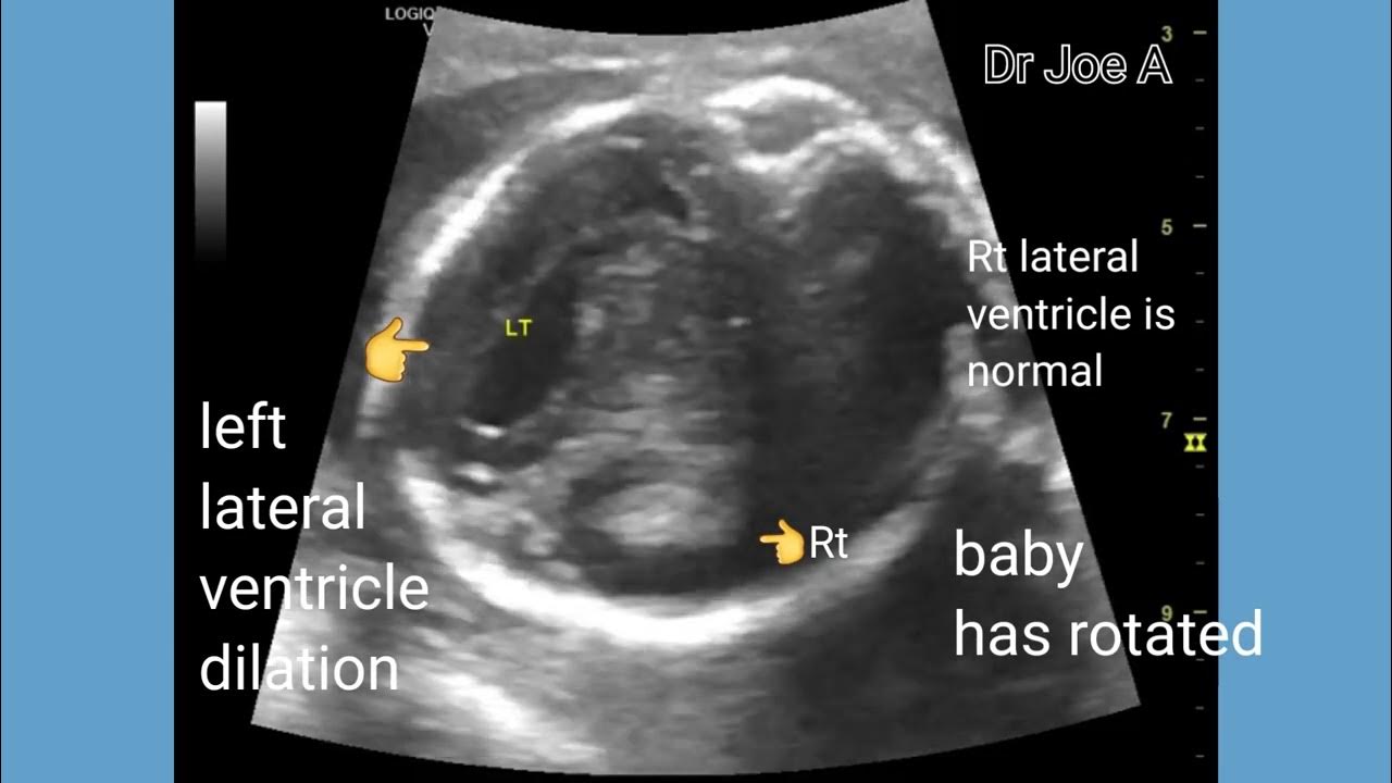 mild-unilateral-dilation-lateral-ventricle-in-fetus-unilateral