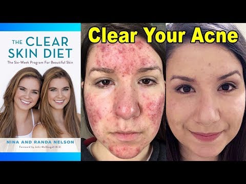 Clear Cystic Acne with Diet - Nina & Randa