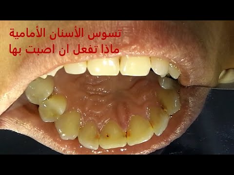 تسوس الأسنان الأمامية وكيف تعالج 