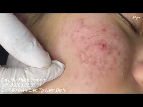 Video Mụn trứng cá siêu nhiều trên bề mặt da. Hotline:... - youtube
