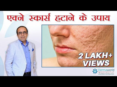 Acne Scars: Causes & How To Get Rid Of Acne Scars | In Hindi | Dr Rohit Batra