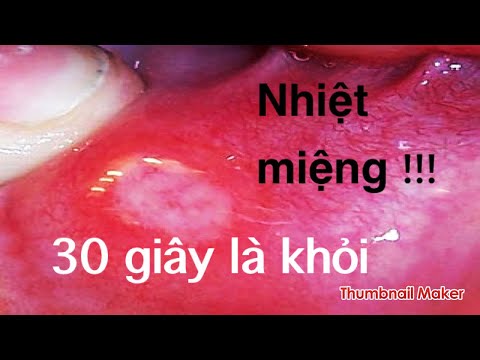 Video Chữa viêm họng, Amiđan, nhiệt miệng, nhiệt lưỡi, hôi... - youtube