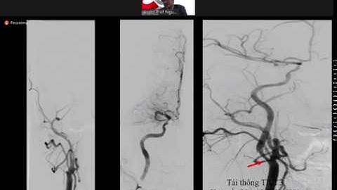 5 Ca lâm sàng đột quỵ cấp - PGS.TS Nguyễn Huy Thắng