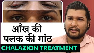 पलक की गाँठ का इलाज | Chalazion (क्लेजियन) / Eyelid Cyst Removal Procedure