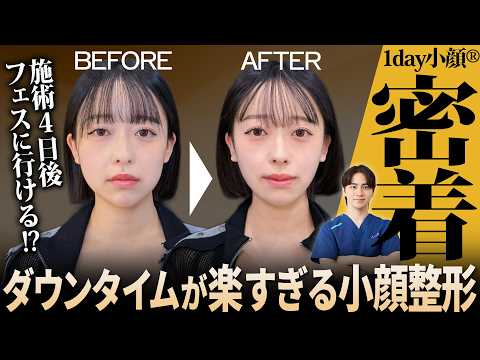 【1day小顔体験】頬まわりの脂肪・ほうれい線っぽい影は変わる？リアル経過を公開