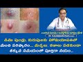 Best treatment for abscesses in Homeopathy medicines | చీము పుండ్లు, కురుపులు | Dr P.V Ramanaidu