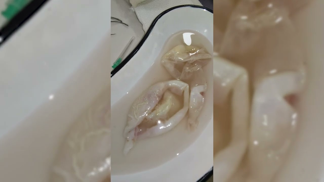 Кисты эхинококка Макропрепарат